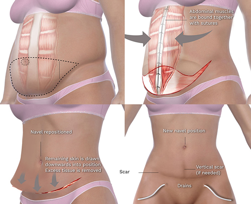 Results Diagram of Tummy Tuck in Beverly Hills CA At Los Angeles Liposuction Center
